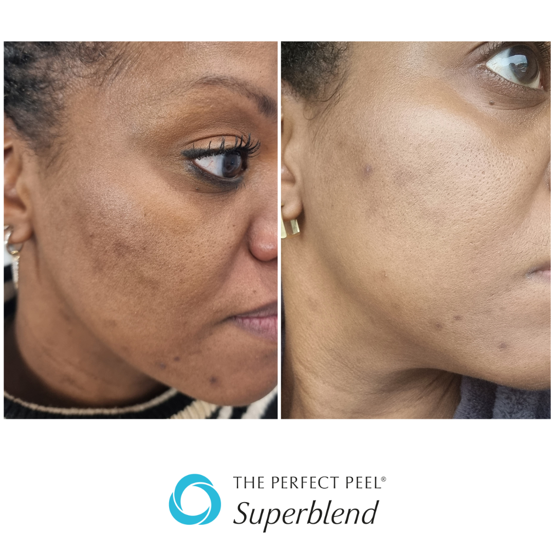 6 weeks after 1 peel.png