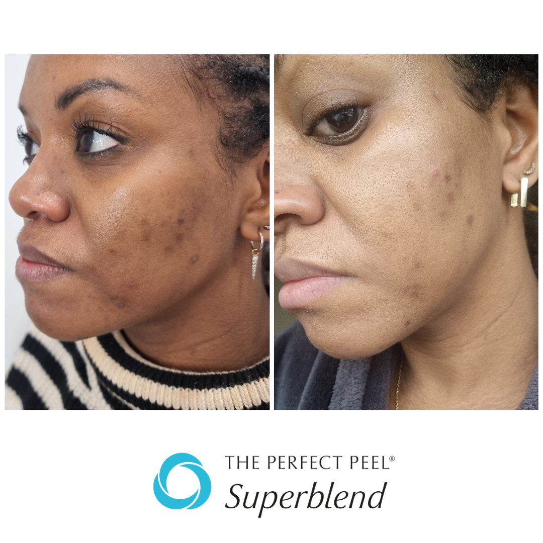 6 weeks after 1 peel b.png