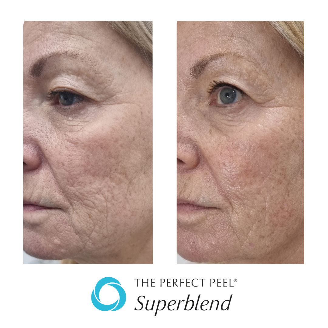TPP Superblend Before After 3.png