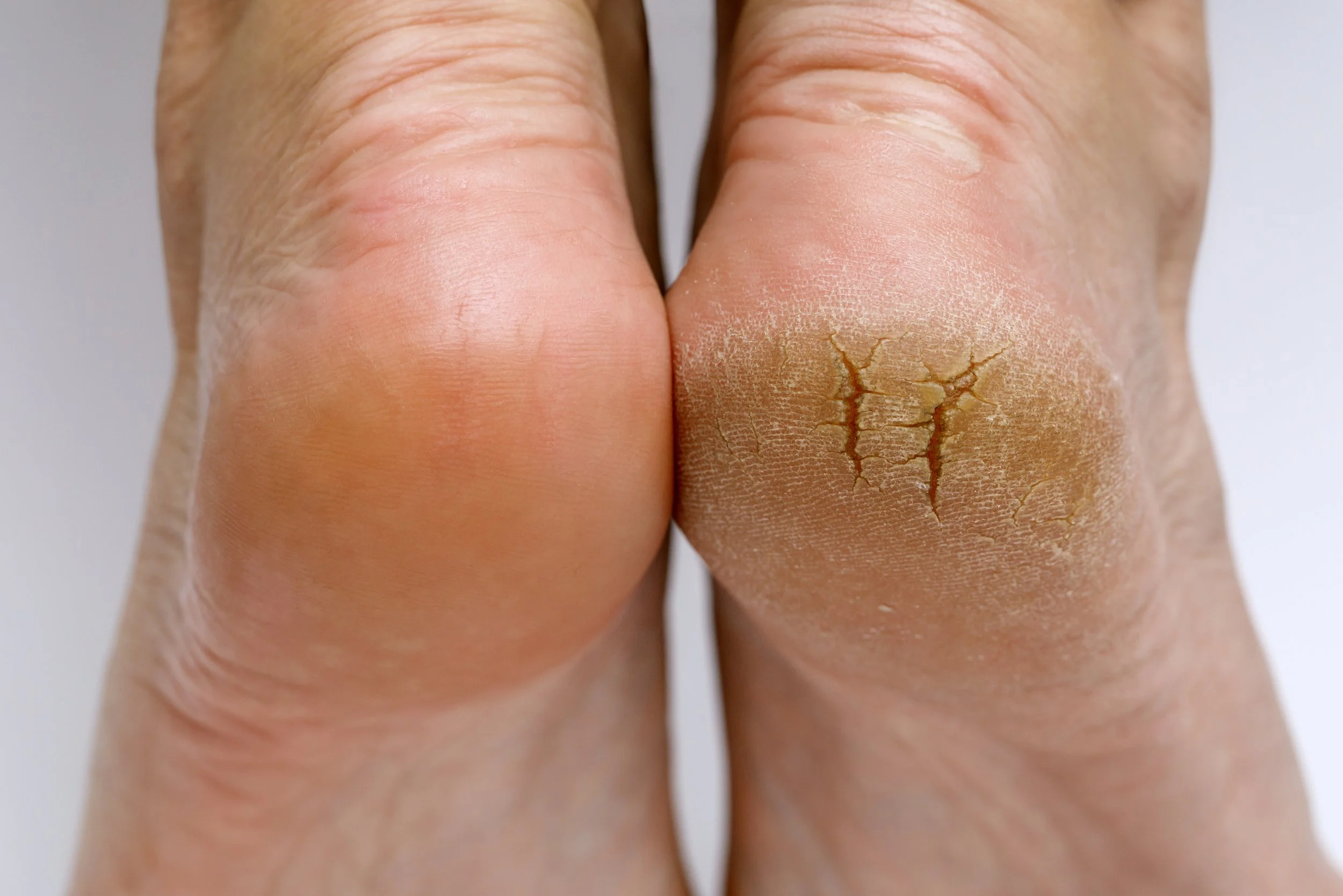 Fissures How To Sore Cracked Heels Remedy Athlete's Foot Cracked