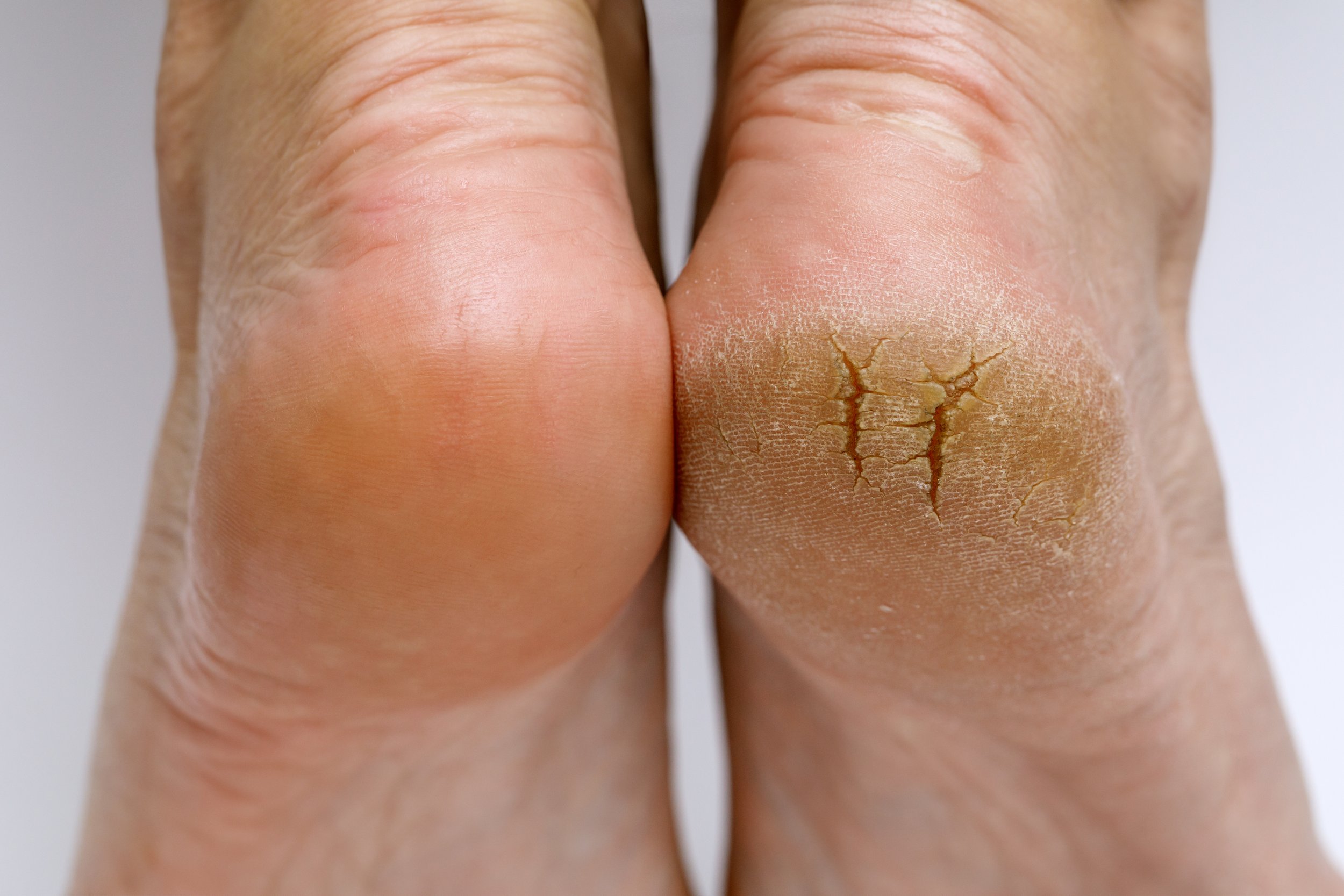 Fissures & Athlete's Feet Treatment | Fort Worth Podiatrist | Podiatrist  located in Fort Worth, TX | Ankle and Foot Institute of Texas