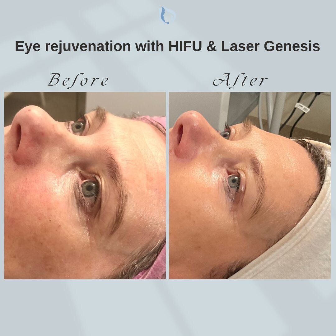 This lovely client got an incredible good result 😍 by combining HIFU and laser genesis in one single session. Lifting of the brow performed with HIFU and laser genesis has been used to rejuvenate the eye area, this will allow new collagen to be prod