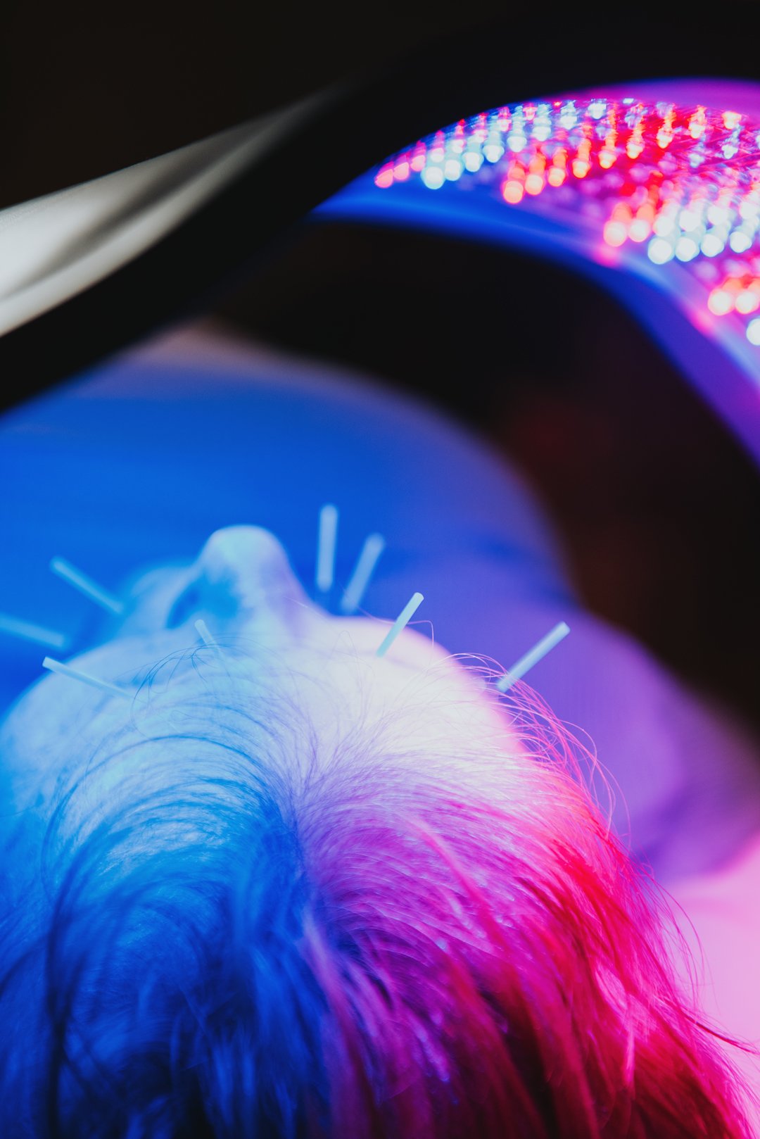Close up of a face with acupuncture needles under UV light therapy 