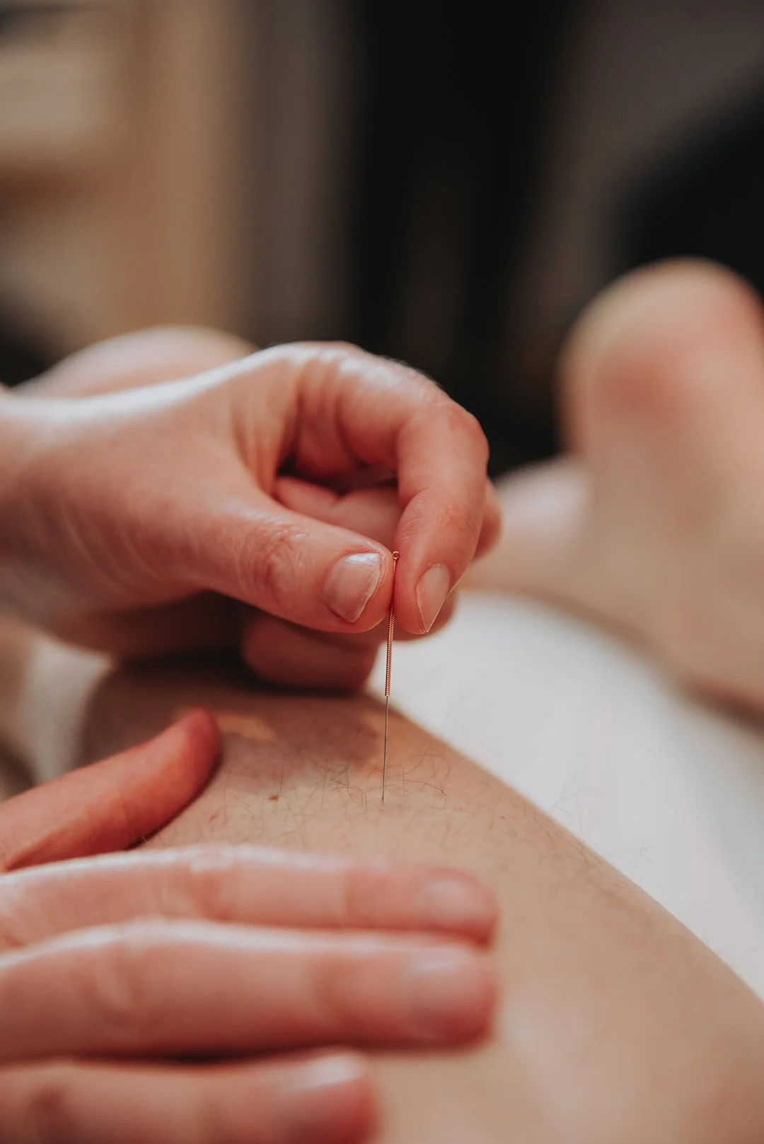 Close up of hands and acupuncture needle.