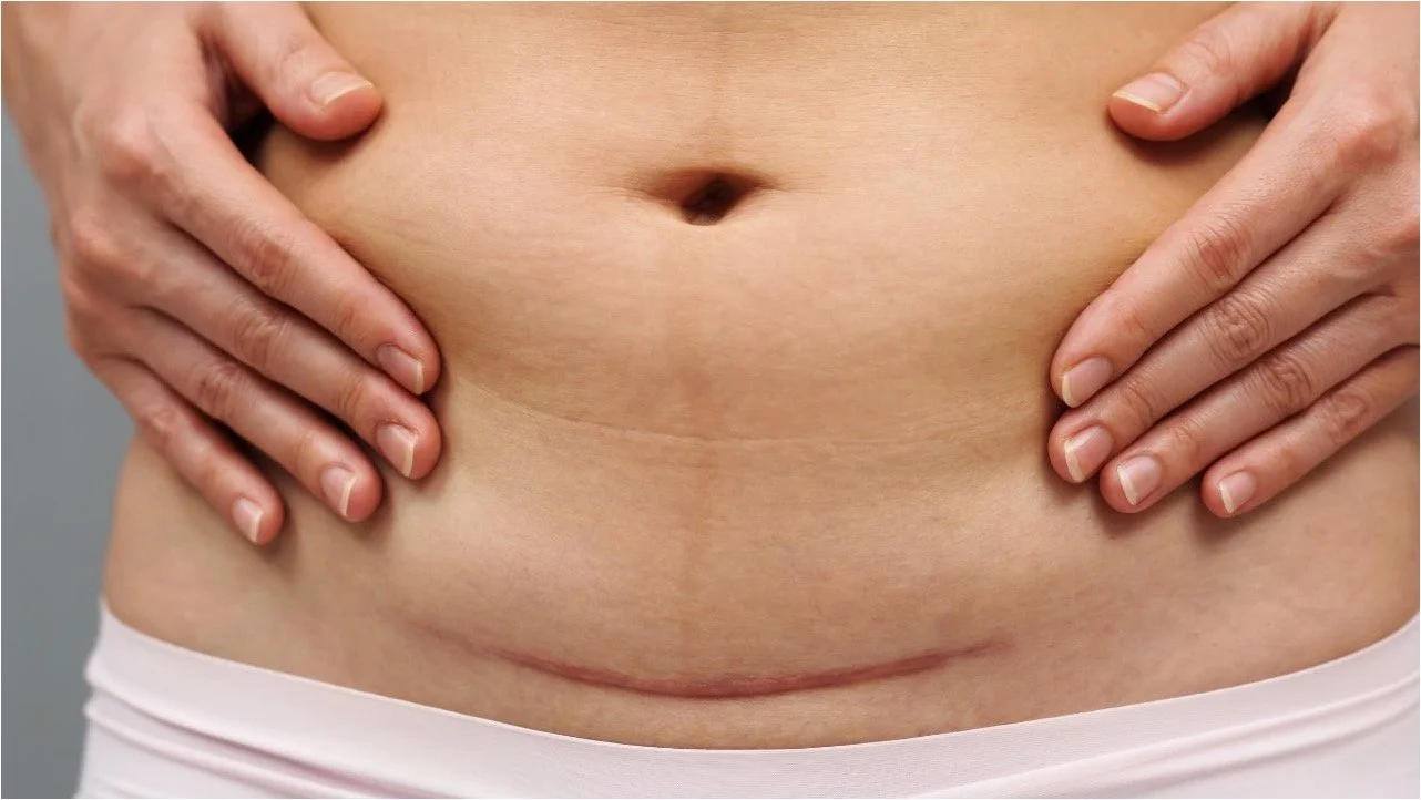 c-section scar