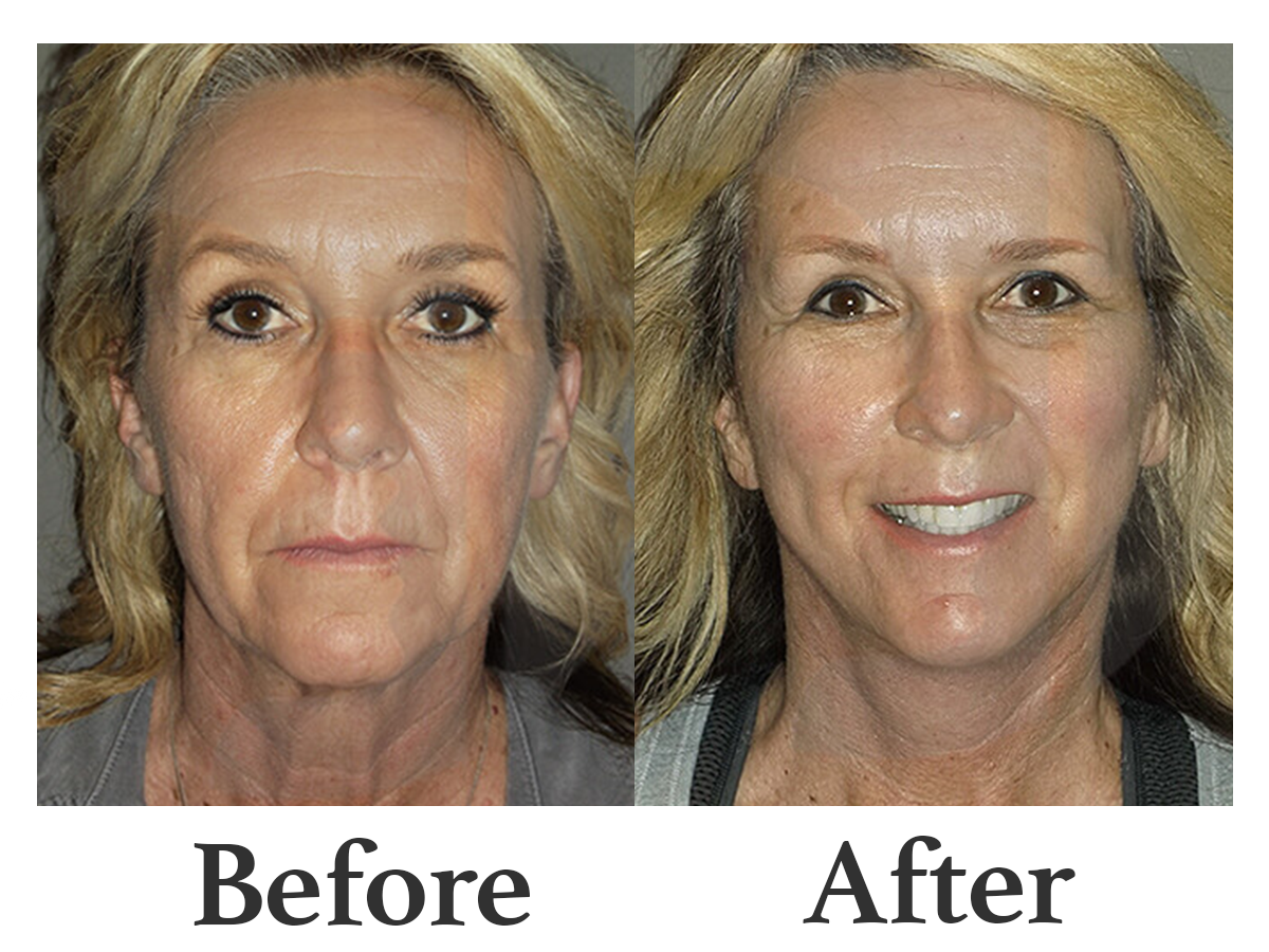Before and After 6.png