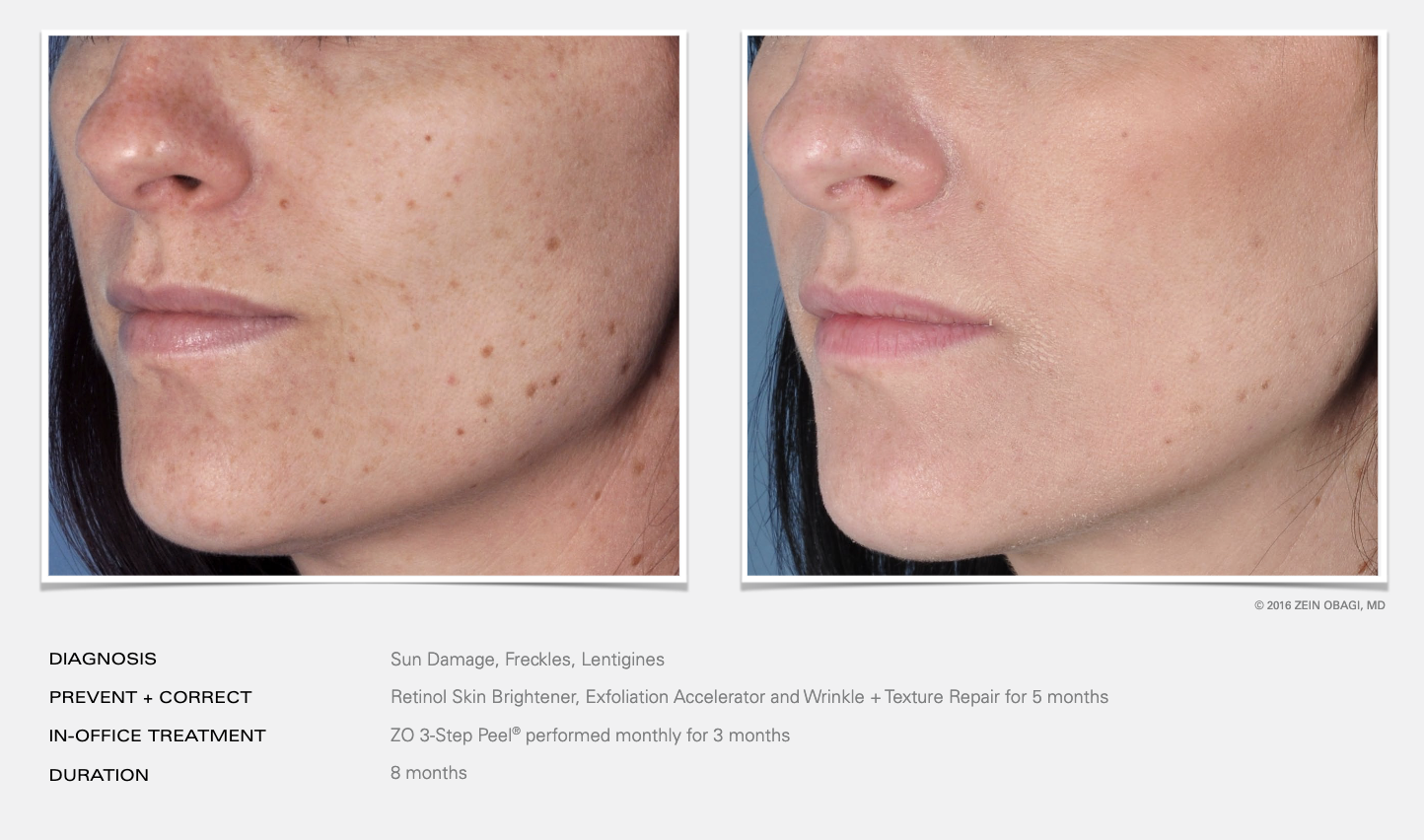 Before and after images showing facial skin improvement with treatment details. "Diagnosis: Sun damage, freckles, lentigines. Prevent + Correct: Retinol skin brightener, exfoliation accelerator, wrinkle + texture repair for 5 months. In-office treatm