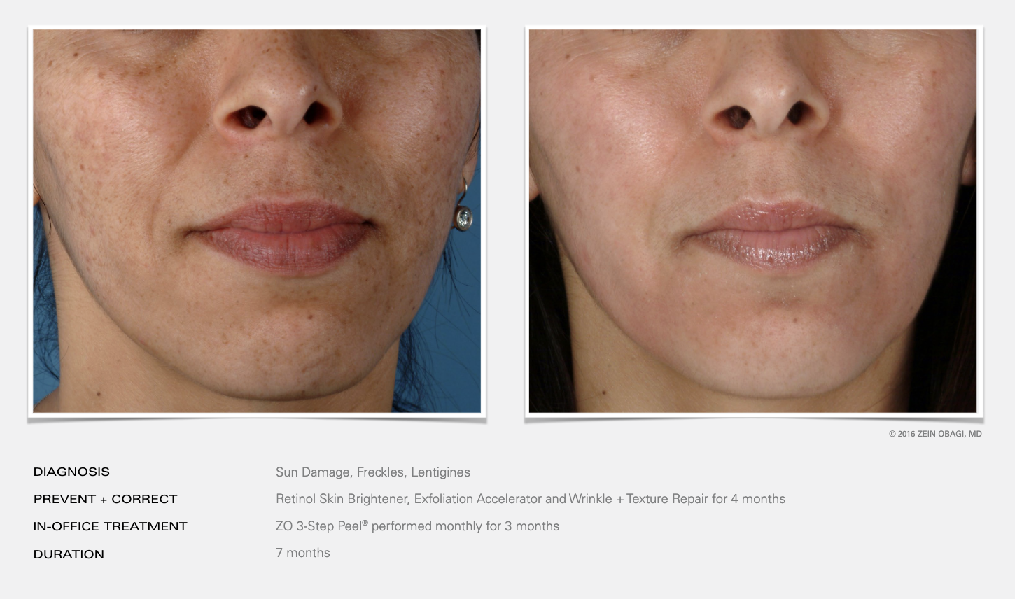 Before and after images of a person's face showing skin improvement. The left image depicts the skin with sun damage, freckles, and lentigines. The right image shows a visibly clearer and smoother complexion after treatment with Retinol Skin Brighten
