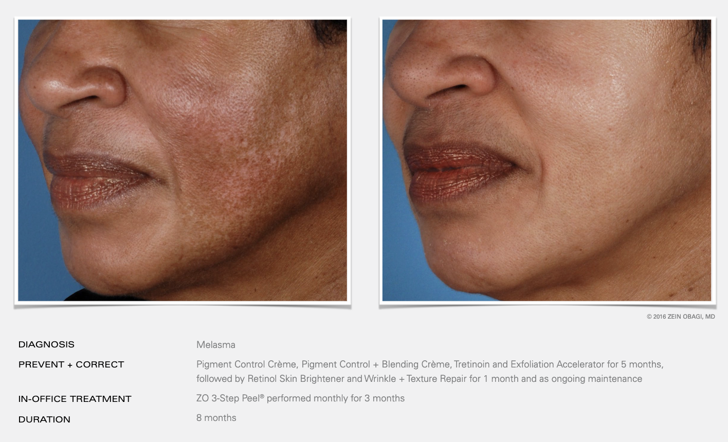 Side-by-side comparison of facial skin before and after melasma treatment, showing improvement in pigmentation and texture after 8 months.