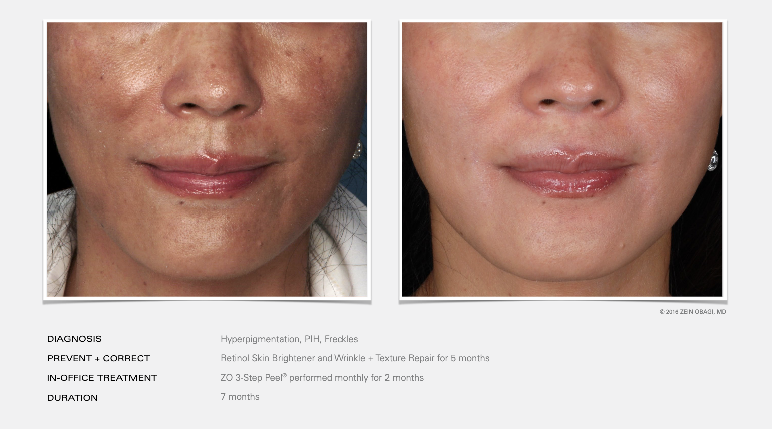 Before and after images showing skin improvement through treatment for hyperpigmentation, PIH, and freckles. Includes a 7-month regimen of Retinol and ZO 3-Step Peel by Zein Obagi, MD.