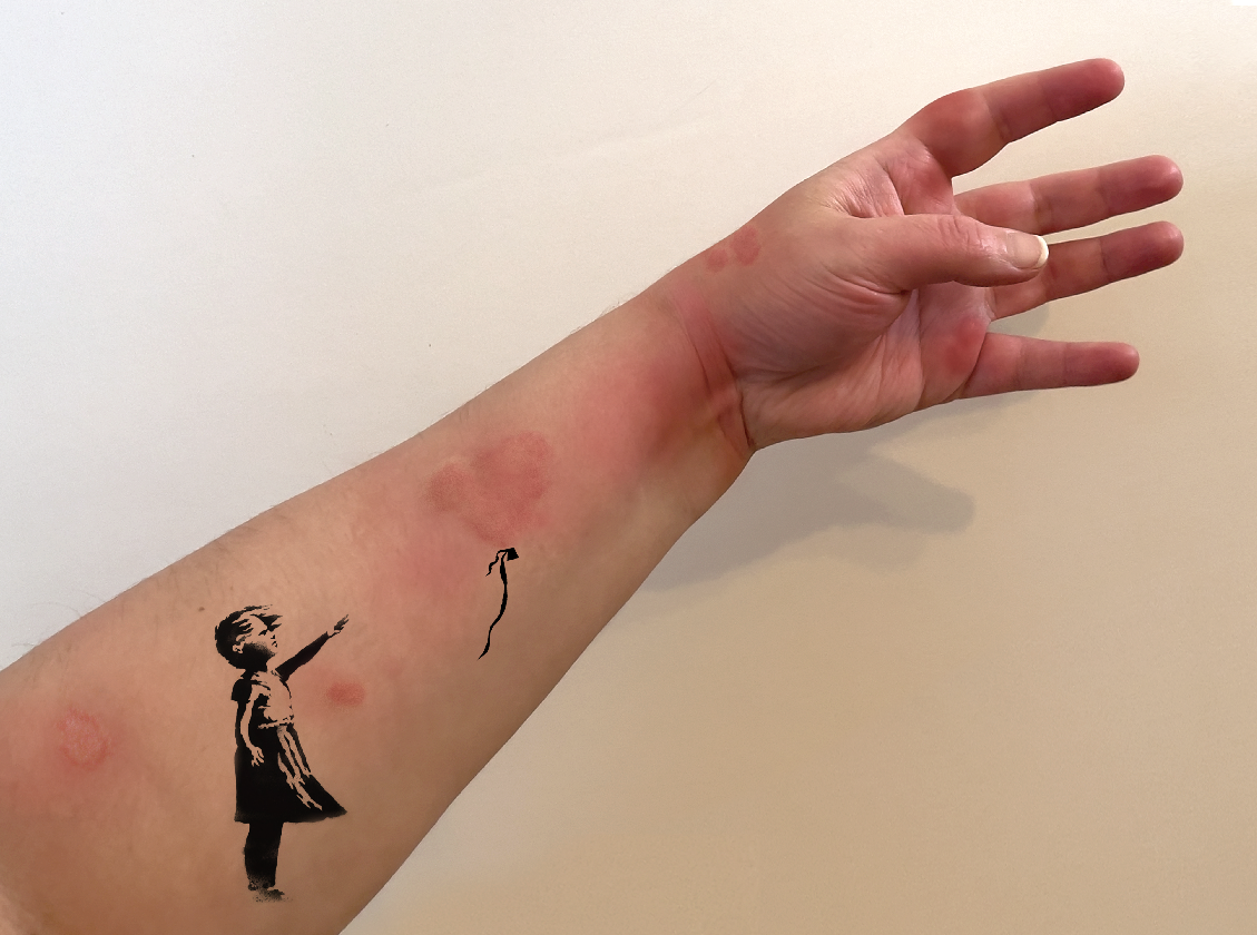 Banksy, Girl with Hives