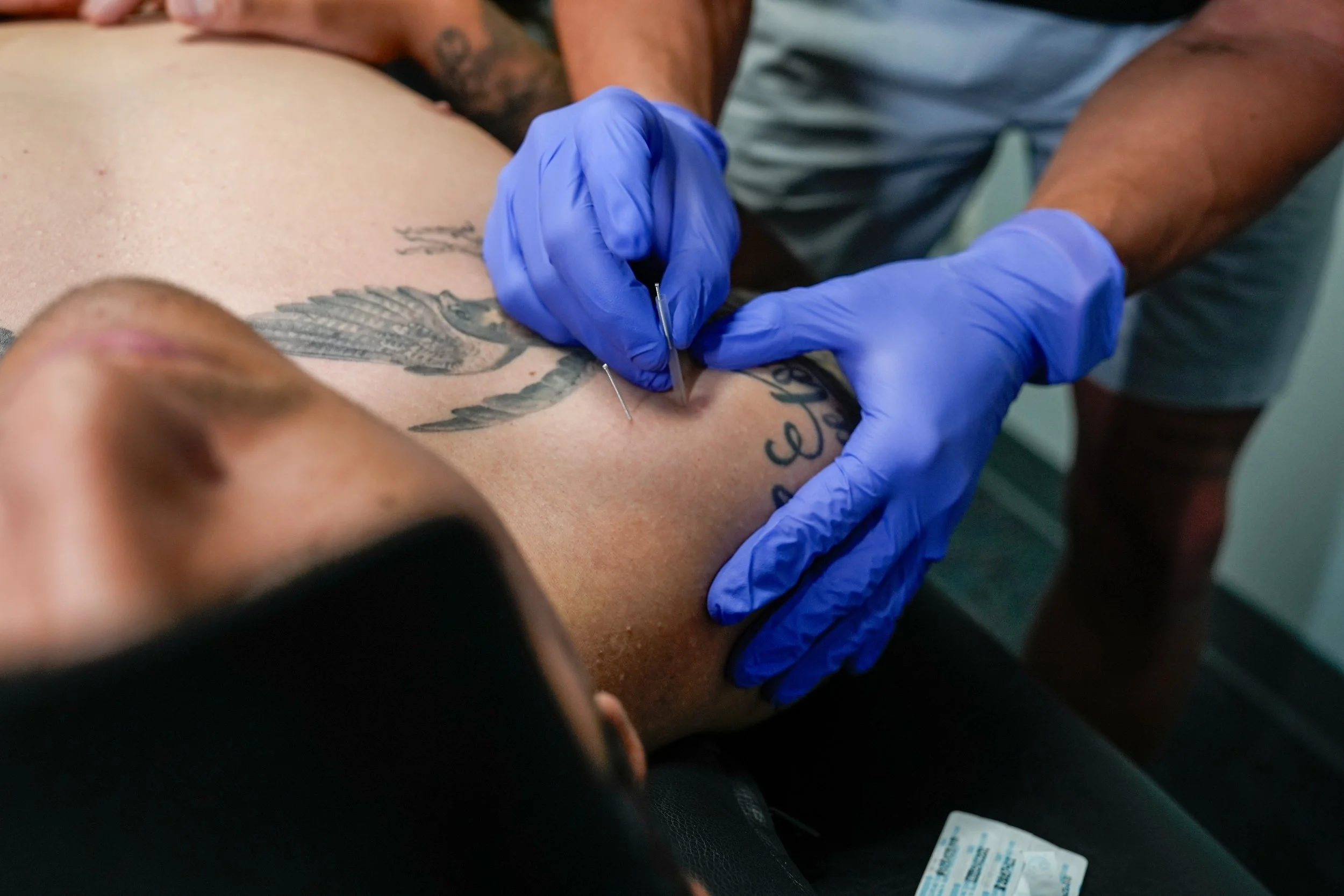 Dry needling treatment at The Movement Doc of Texas in New Braunfels