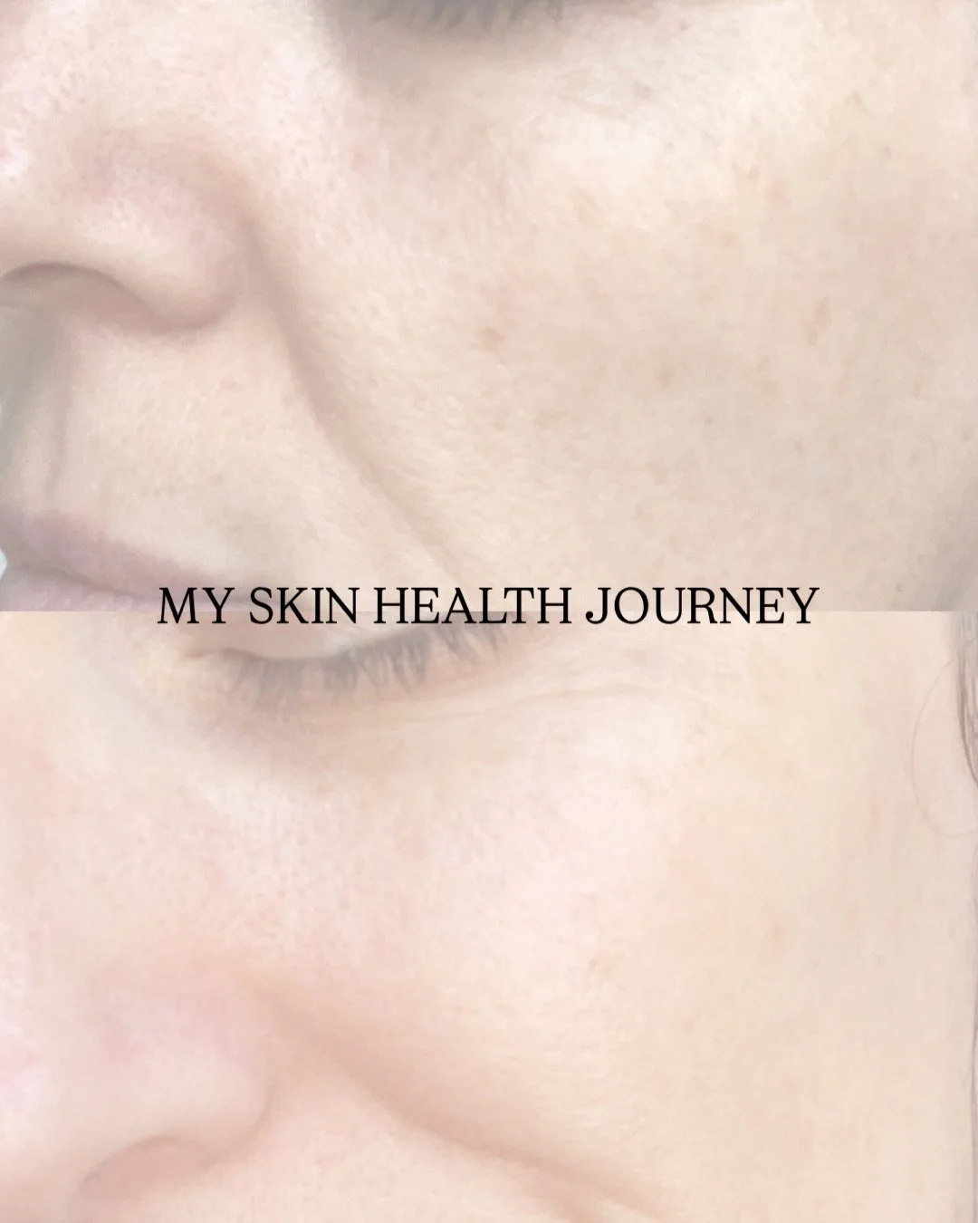 This is me:

July 2024, aged 39, freshly qualified in skincare and without a real routine of my own.

June 2025, aged 40 and slowly becoming consistent with quality skincare.

I&rsquo;m SO happy with the changes seen here and since then.

From June 2