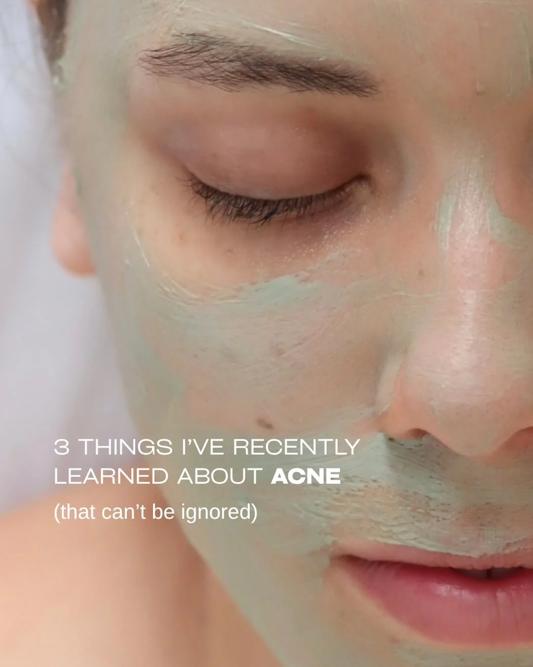 ACNE CLARITY
Acne is a blockage or infection of the hair follicle and sebaceous (oil) gland. So whilst cleansing is important, acne isn&rsquo;t a hygiene issue.

Imbalances in sebum quality, cell turnover, and the skin&rsquo;s PH need to be prioritis