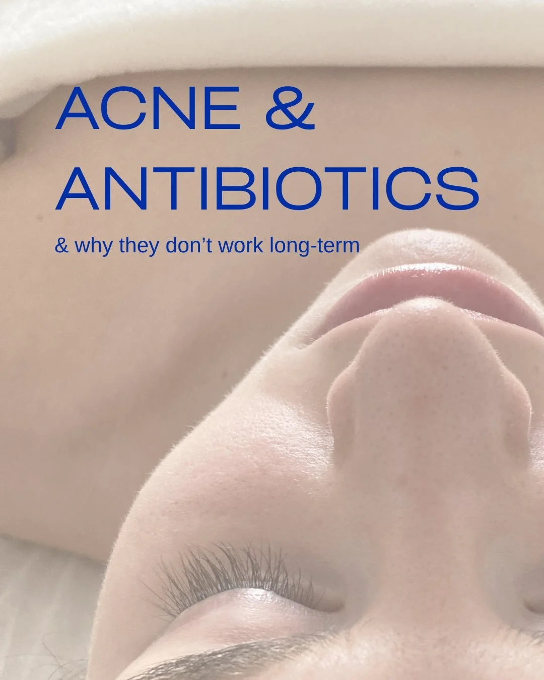 Acne &amp; antibiotics.

Just because bacterial overgrowth of a very specific bacteria is part of the acne ladscape, doesn&rsquo;t mean that antibiotics are the way to go in treating acne.

Get in touch if you&rsquo;d like some help in understanding 