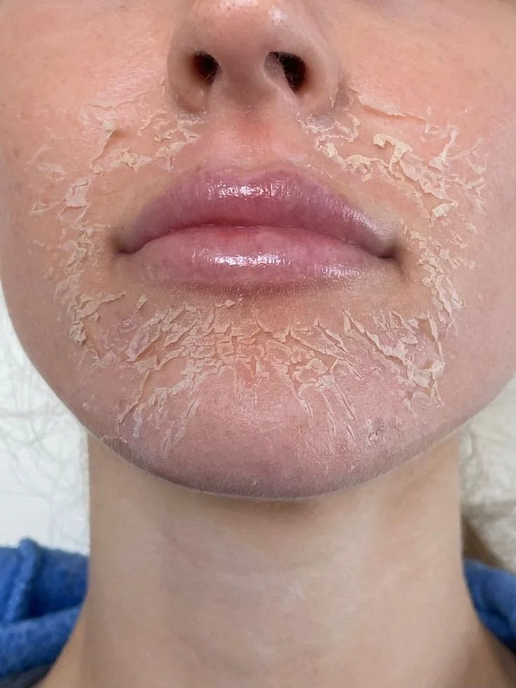 Vi Peel Chemical peel buy 3 get one 50% off