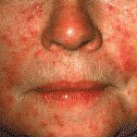 Facial redness