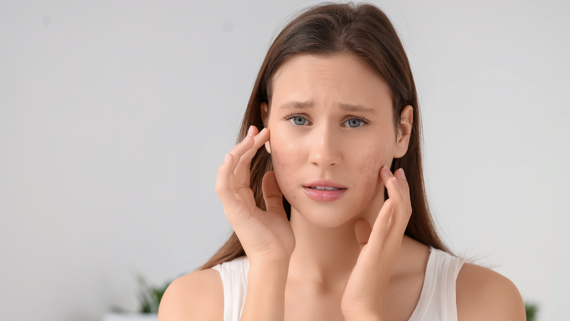 Adult Acne Isn’t a Surface Problem. It’s a Systemic Signal.