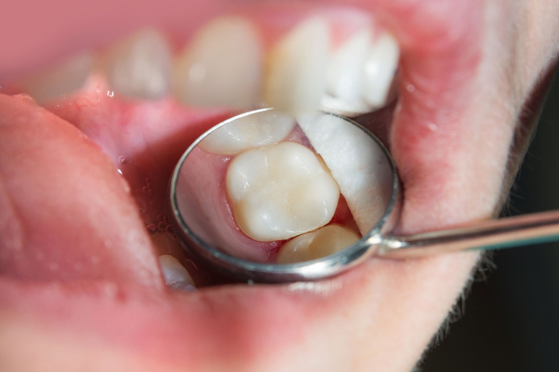 What are Dental Fillings?