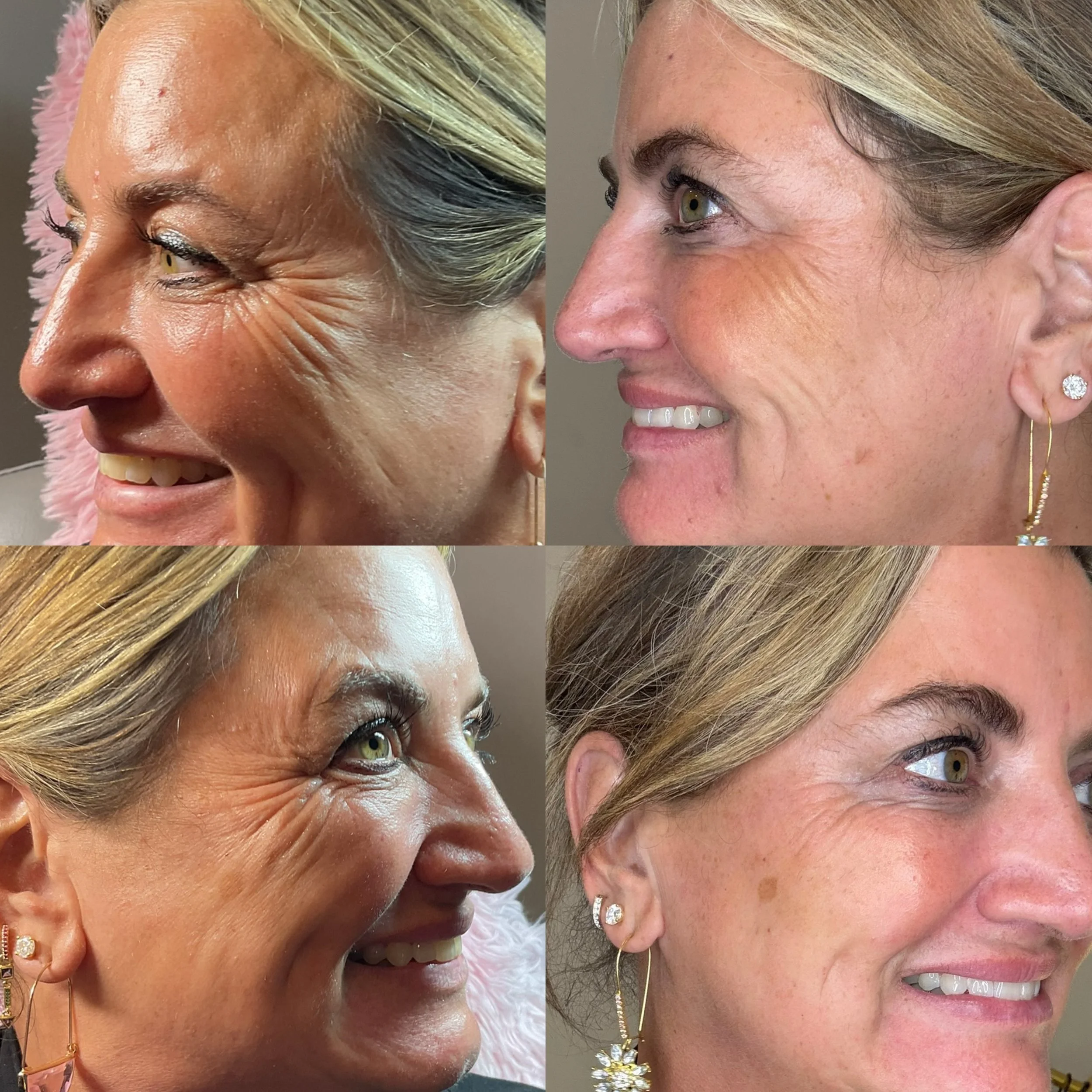 Just a ONE WEEK difference! Nothing a little toxin can&rsquo;t fix 😁🙌

Results by our Wellness &amp; Aesthetics RN, Tracey!!! 

Ready to kiss your crows feet goodbye? 👋 Book with Tracey at our BACK TO SCHOOL event next Thursday August 20th from 9 