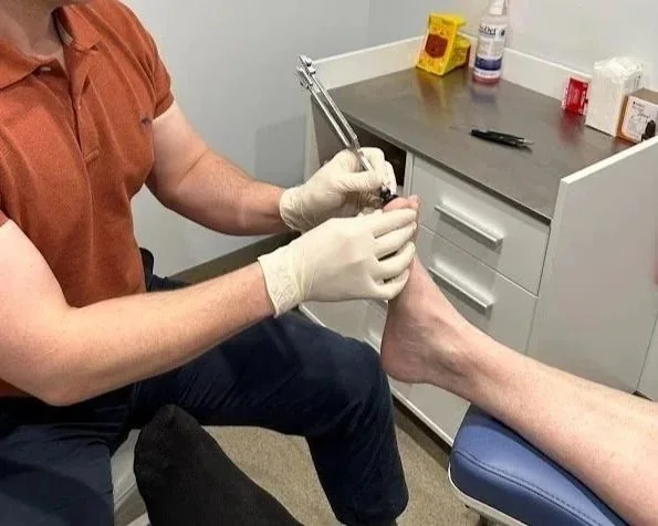 Ingrown Toenail Surgery