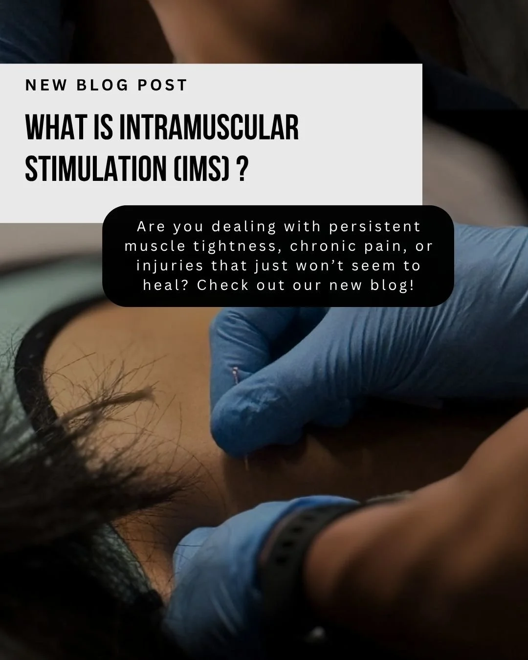 What Is IMS (Intramuscular Stimulation)?&nbsp;