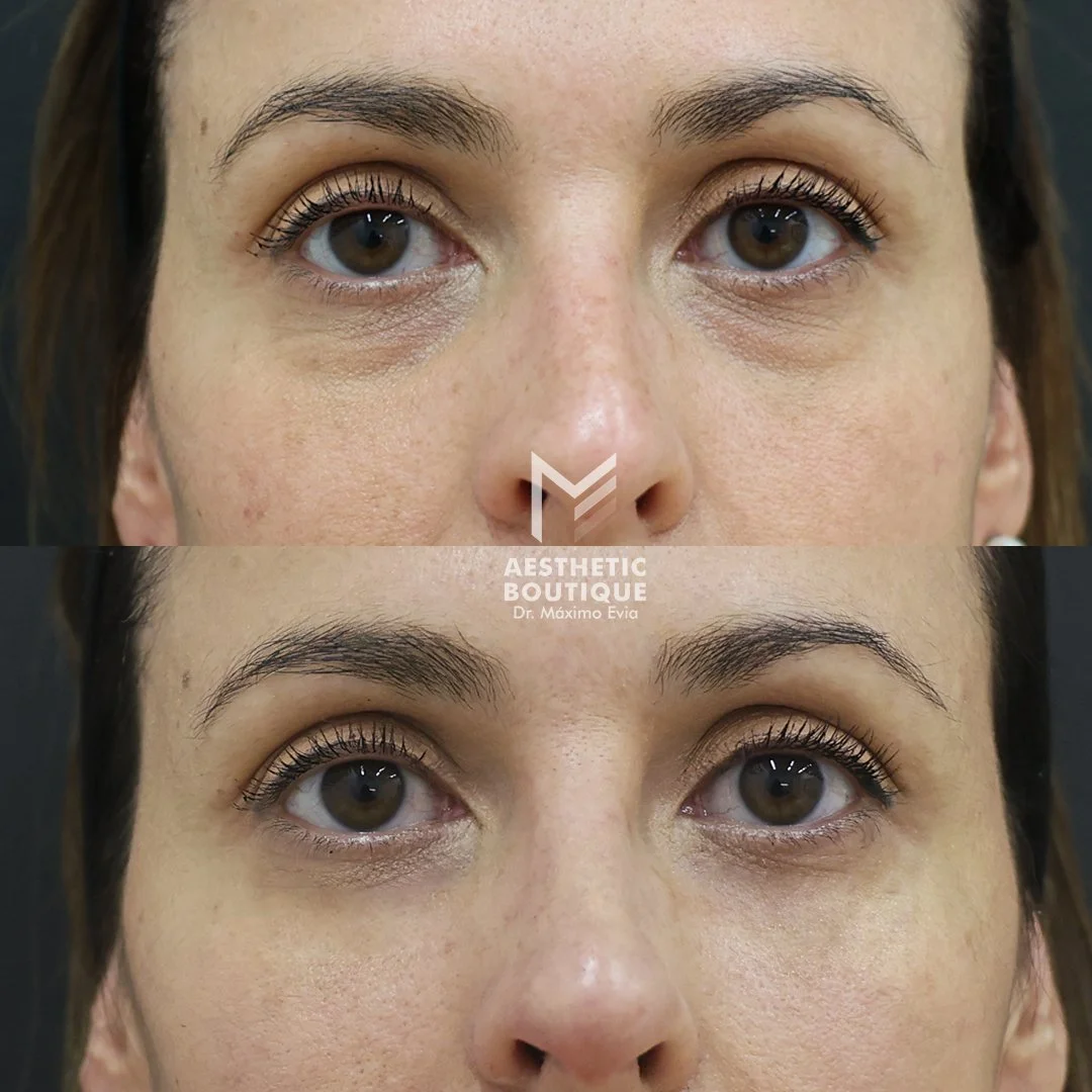 Correción de ojeras