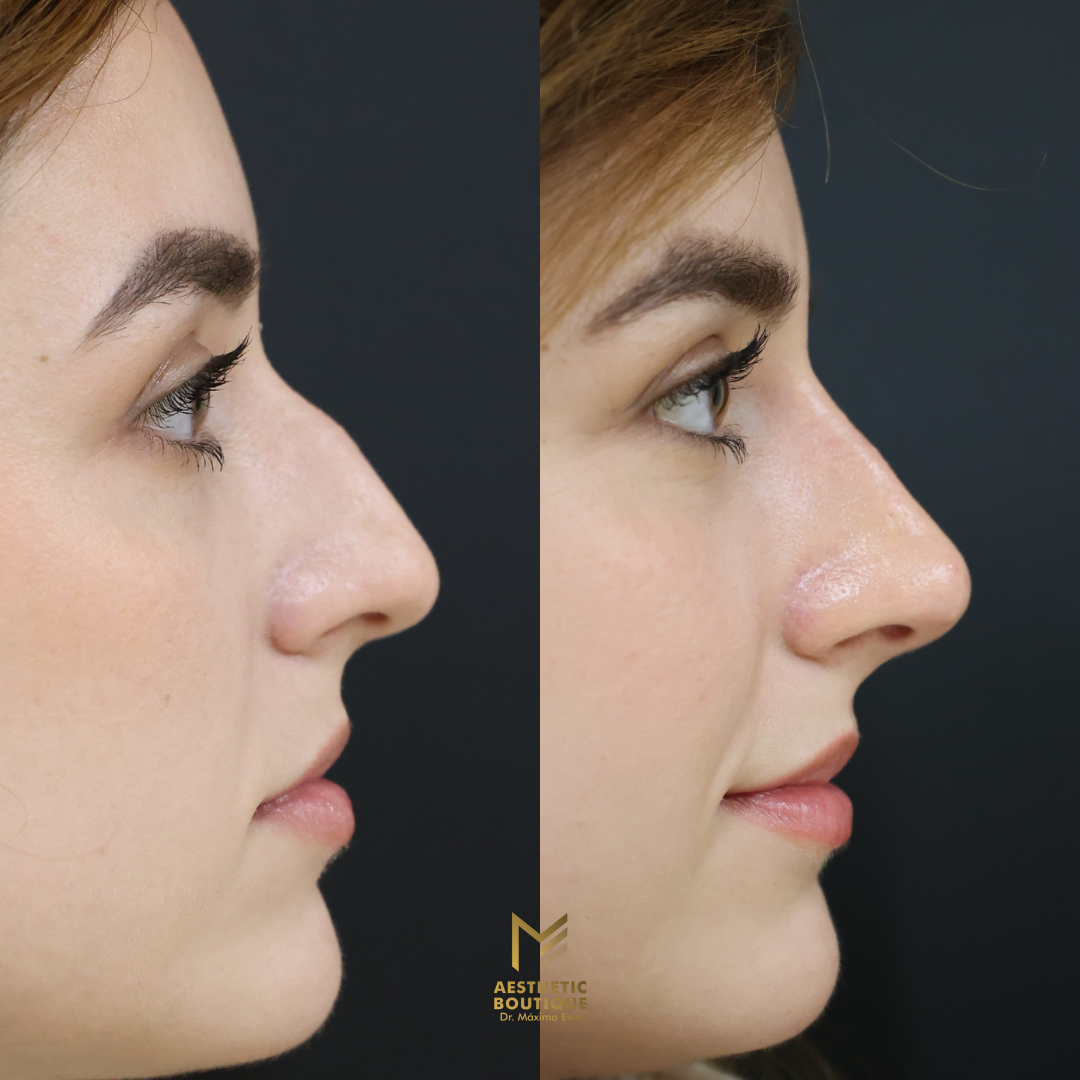 Perfil de paciente, rinomodelación