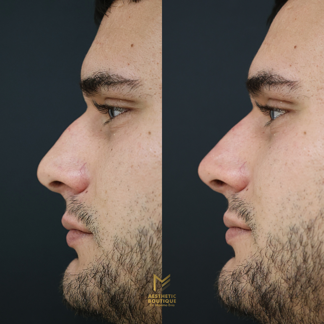 Rinomodelación Masculina