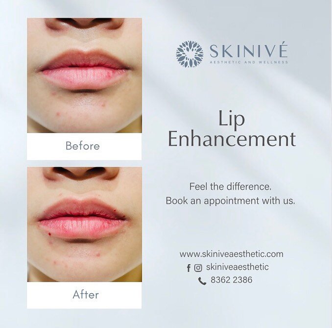 LITTLE &lsquo;tweakments&rsquo; can make a BIG difference. 

Skiniv&eacute;&rsquo;s Lip enhancement uses Hyaluronic Acid Fillers to add volume, give shape and protrude lip projection to give that plump, hydrated and sultry lips. 

Lip Fillers usually
