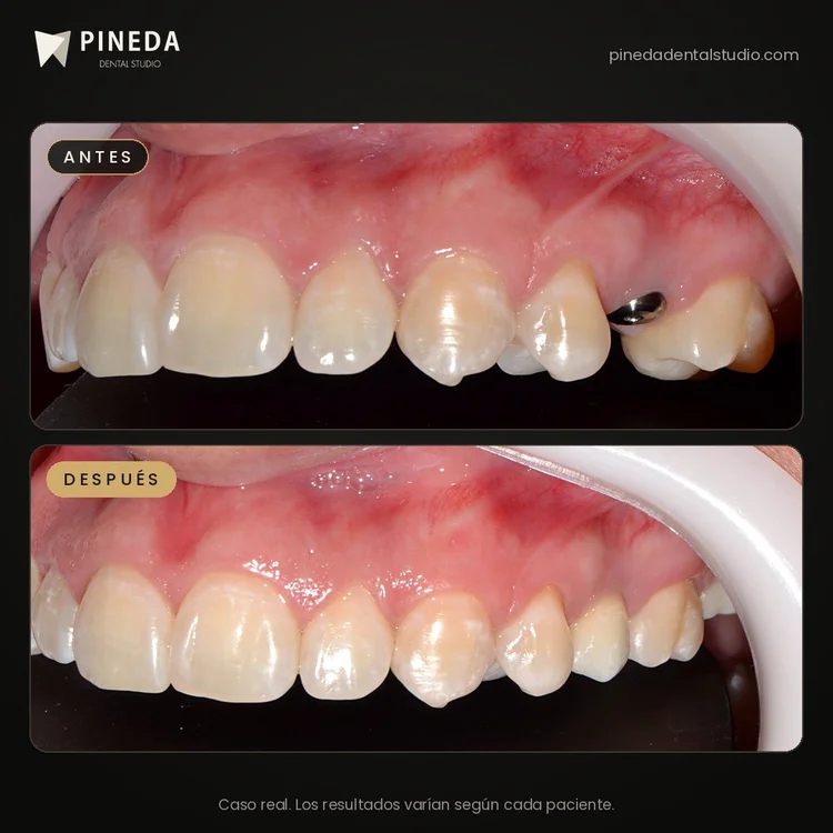 Antes y después de un implante dental con corona definitiva en Pineda Dental Studio, Recoleta, CABA