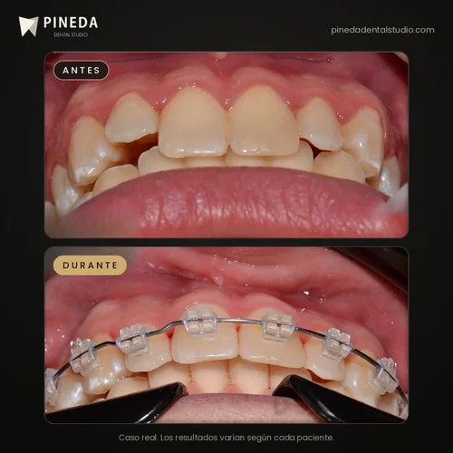 Antes y durante un tratamiento de ortodoncia estética en Pineda Dental Studio, Recoleta, CABA