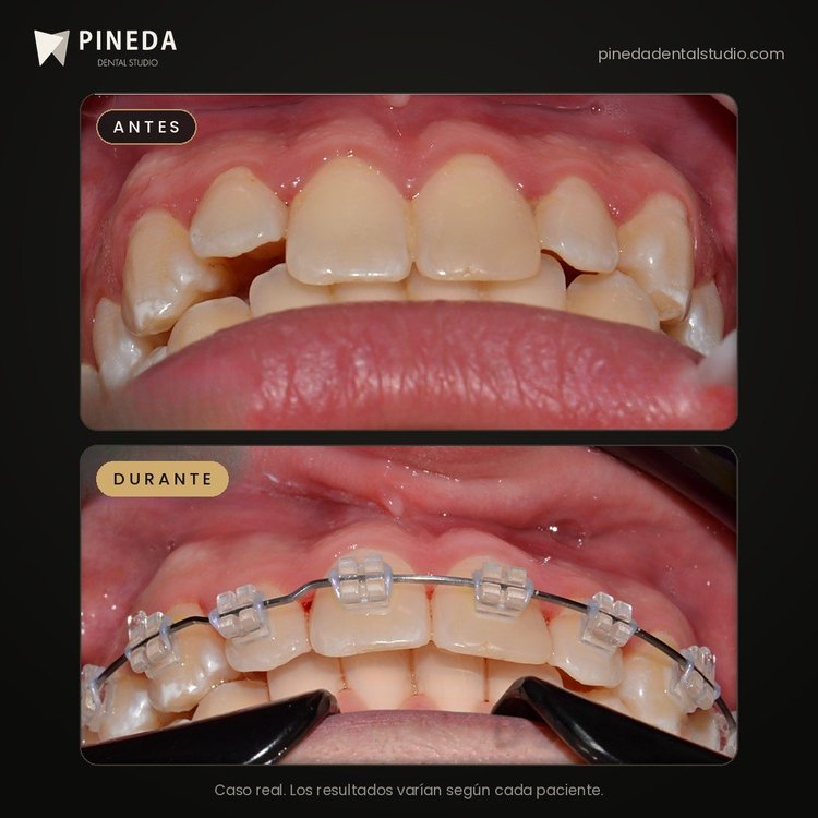 Antes y durante un tratamiento de ortodoncia con brackets estéticos en Pineda Dental Studio, Recoleta, CABA.