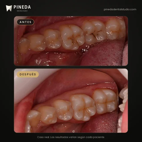 Antes y después de restauraciones de resina en muelas en Pineda Dental Studio, Recoleta, CABA