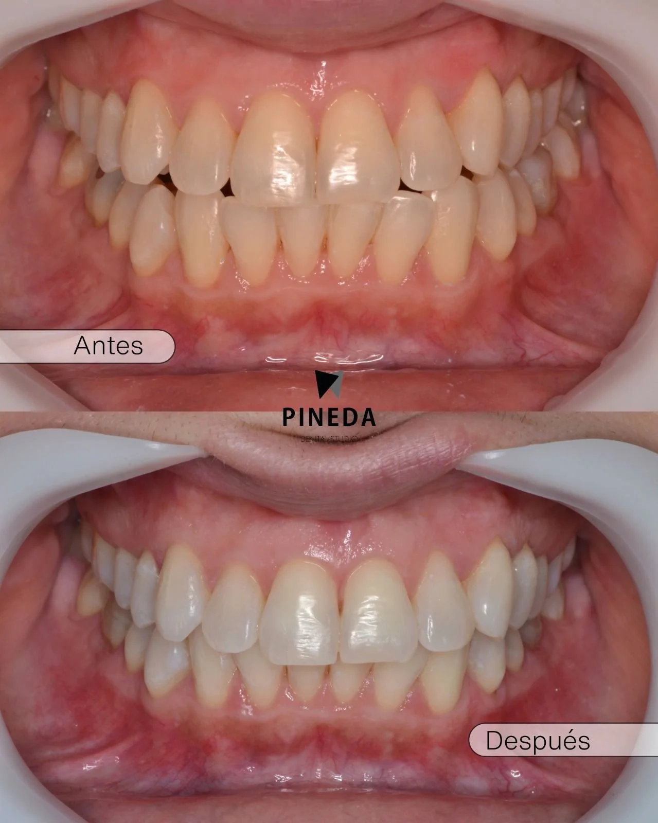 Comparativa de antes y después de un blanqueamiento dental clínico utilizando tecnología de láser de diodo en Pineda Dental Studio recoleta caba.