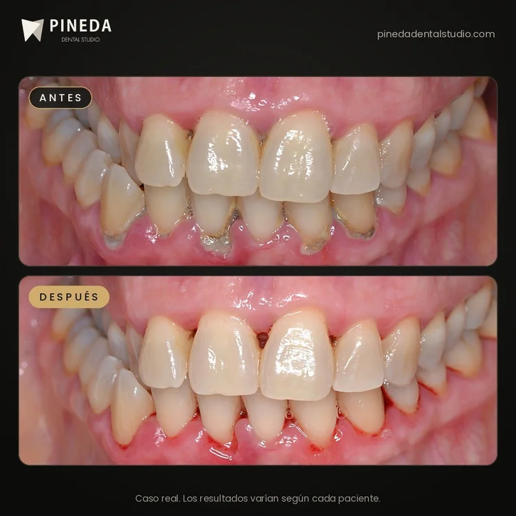 Antes y después de la primera etapa de una terapia básica periodontal con eliminación de sarro en Pineda Dental Studio, Recoleta, CABA.