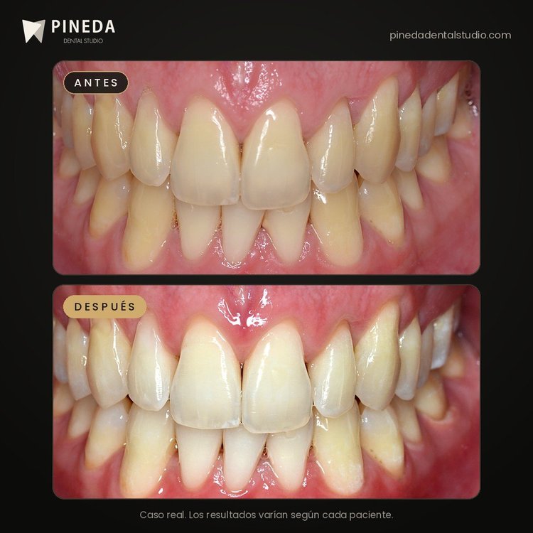 Antes y después de un blanqueamiento dental LED en 3 sesiones en Pineda Dental Studio, Recoleta, CABA.