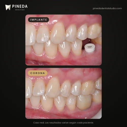 Before and after a dental implant with a ceramic crown at Pineda Dental Studio, Recoleta, Buenos Aires