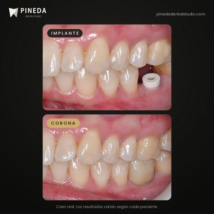 Antes y después de un implante dental con su corona de cerámica en el sector posterior en Pineda Dental Studio, Recoleta, CABA.