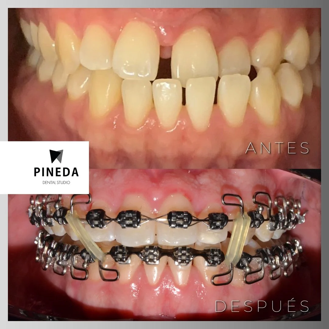 Comparativa de antes y después mostrando la corrección de espacios dentales con ortodoncia fija metálica tradicional en Recoleta-CABA