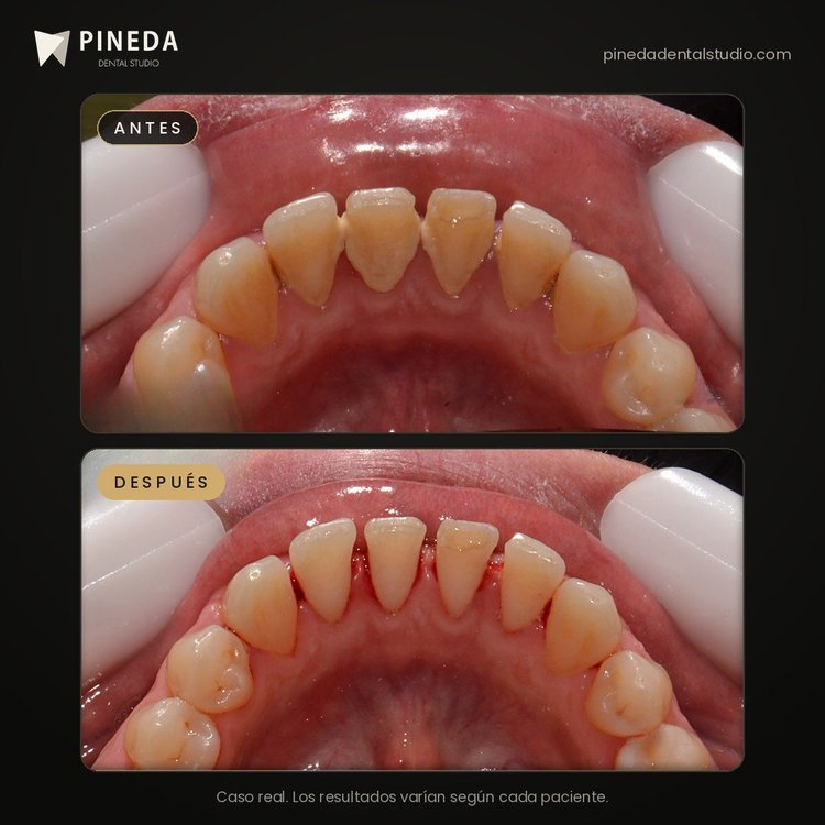 Antes y después de una profilaxis profunda en Pineda Dental Studio, Recoleta, CABA.