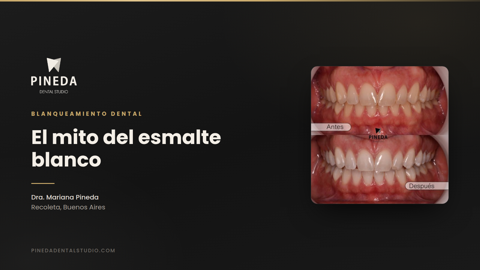 El mito del esmalte blanco: por qué tus dientes se oscurecen donde el cepillo no llega
