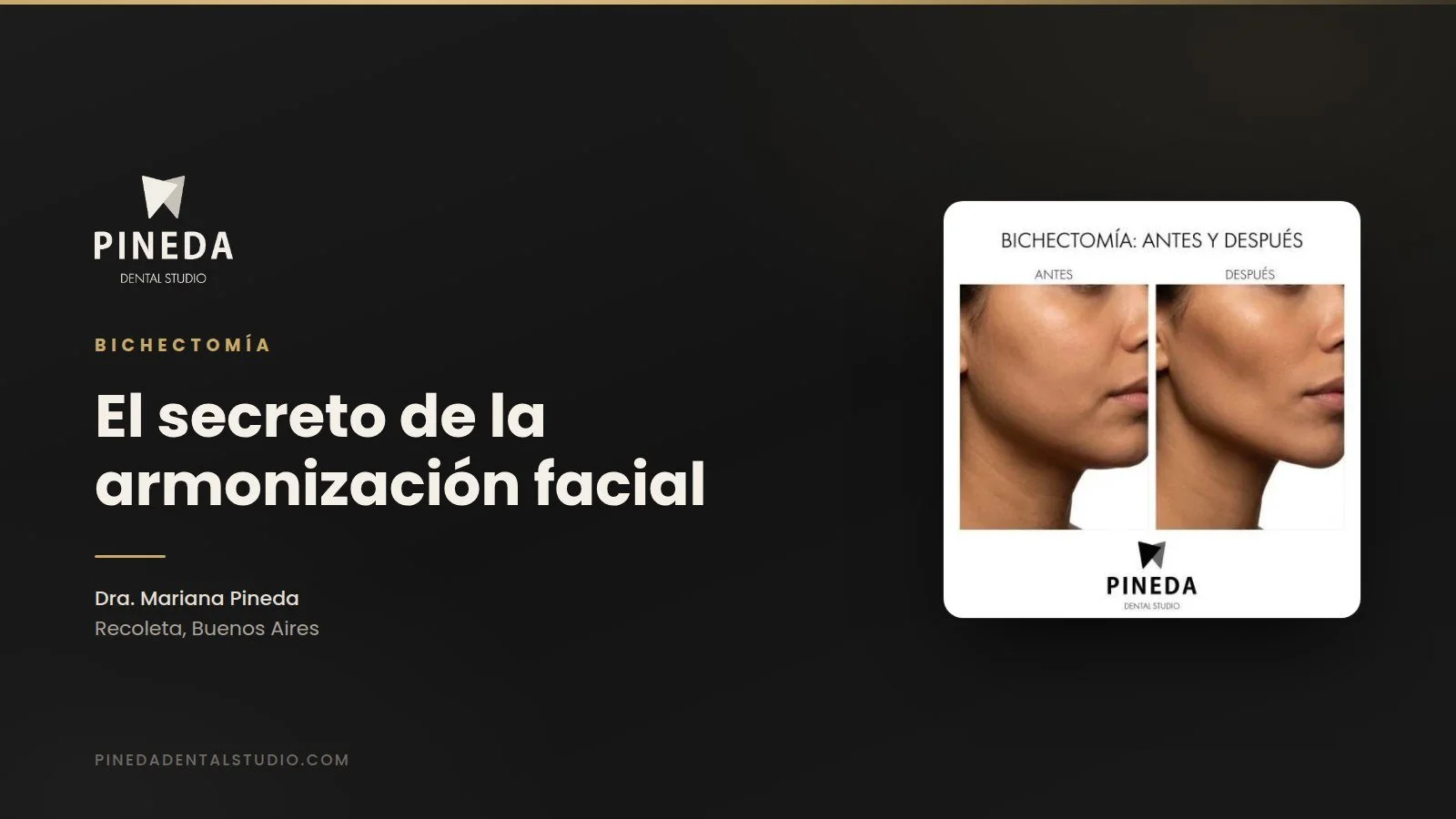 Bichectomía: el secreto de la armonización facial para un rostro más estilizado y definido
