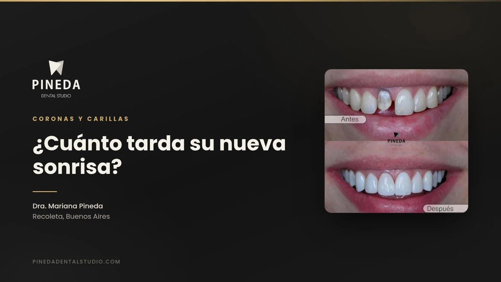 ¿Cuánto tiempo lleva transformar tu sonrisa? La verdad sobre los plazos en coronas y carillas dentales