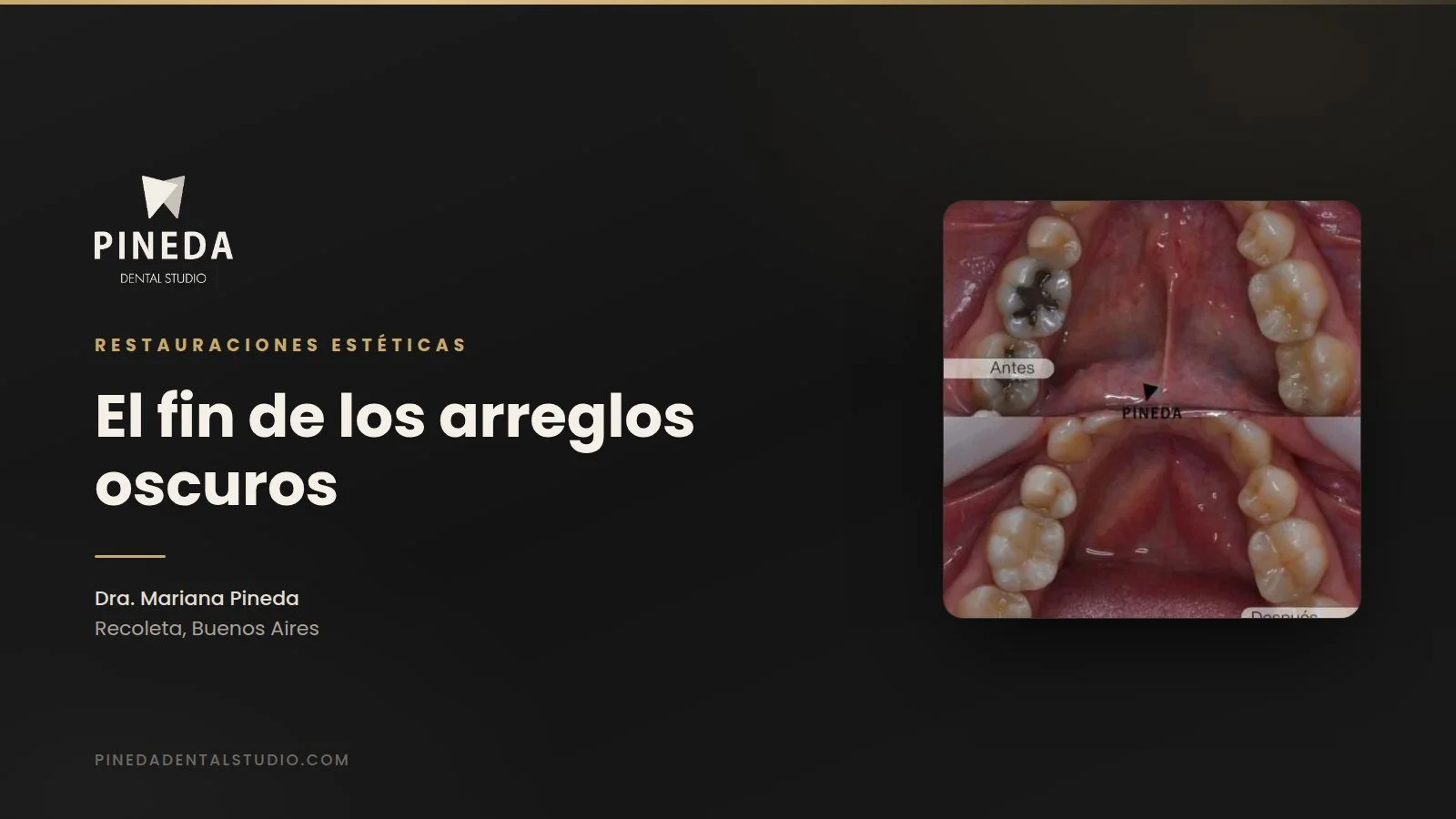 El fin de los arreglos oscuros: por qué cambiar tus viejas amalgamas es una inversión en la salud de tu sonrisa