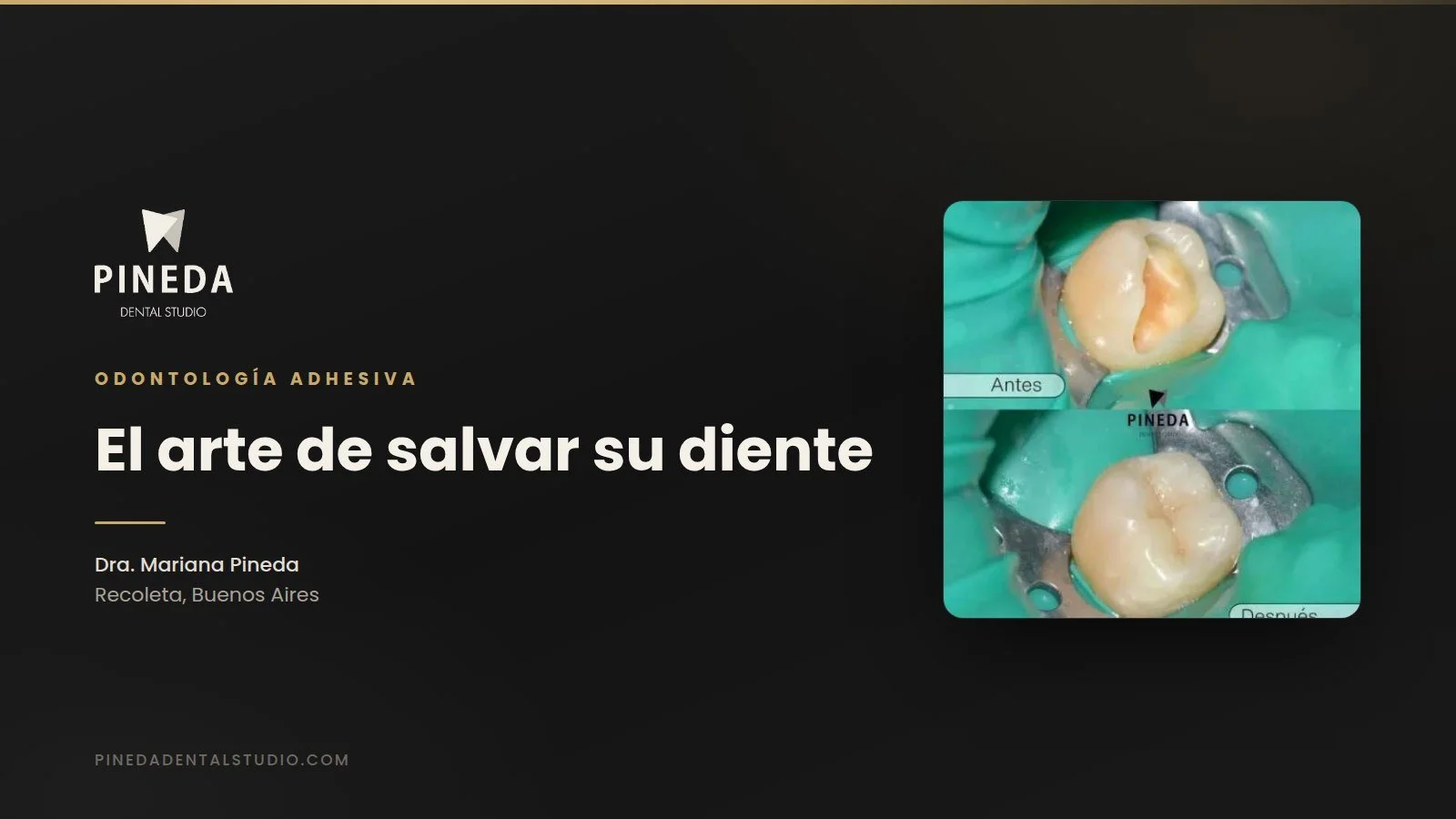 El arte de salvar tu diente: por qué la odontología adhesiva es el fin de las coronas tradicionales
