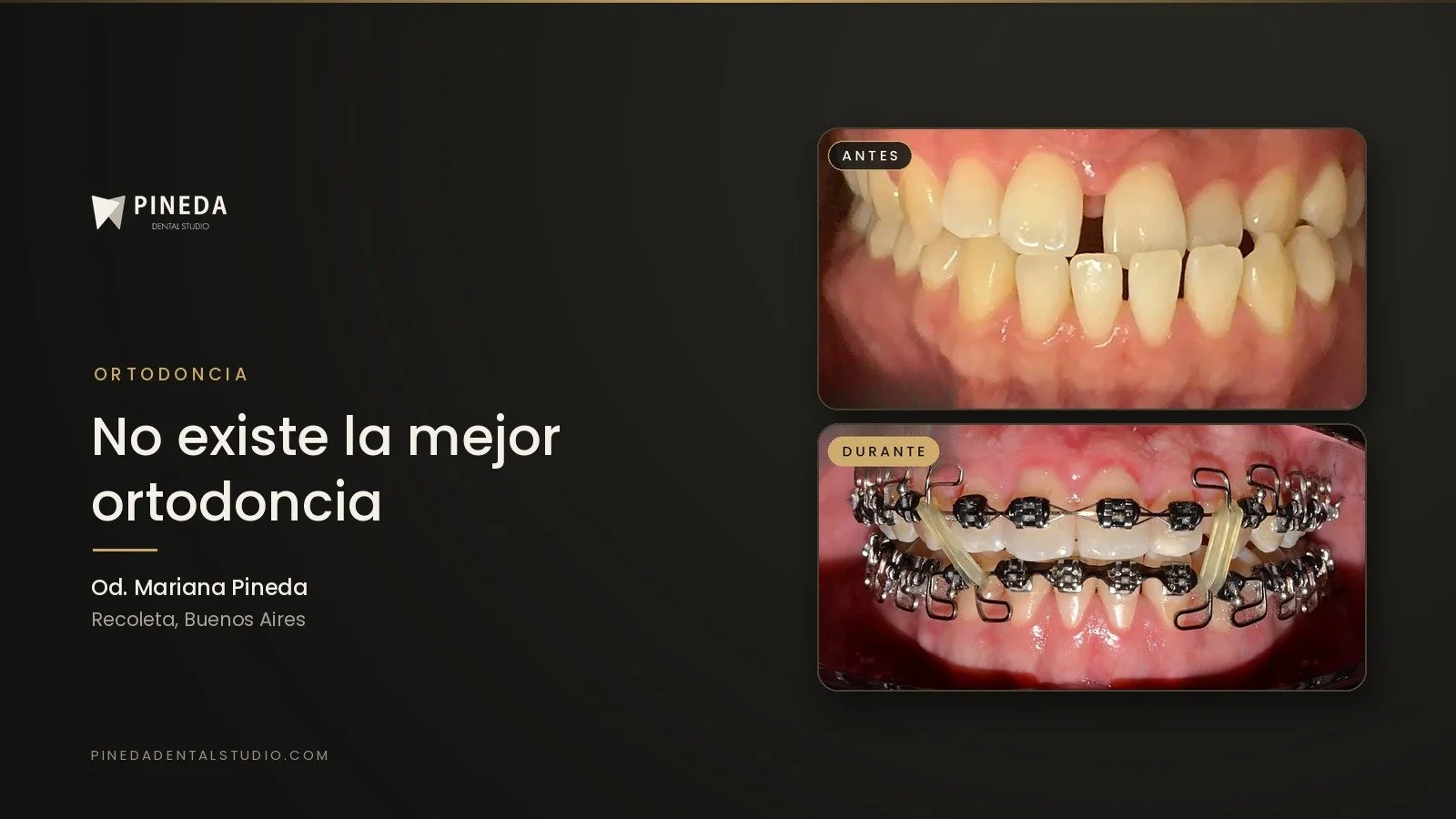 No existe la mejor ortodoncia: brackets, autoligado o alineadores, cuál conviene en cada caso