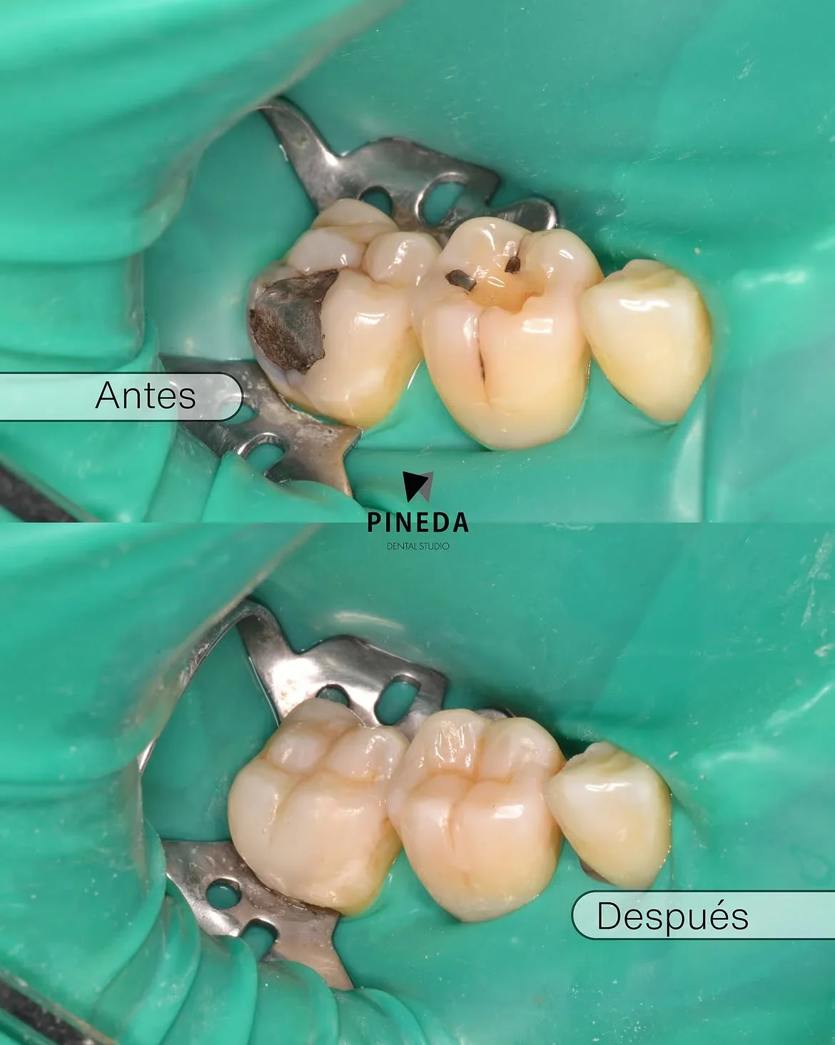 RESTAURACIONES DIRECTAS