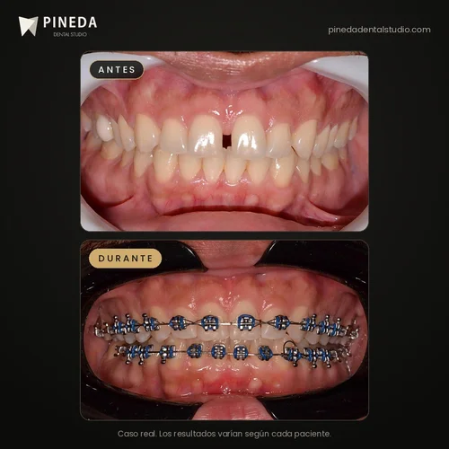 Antes y durante una ortodoncia con brackets metálicos para cerrar un diastema en Pineda Dental Studio, Recoleta, CABA