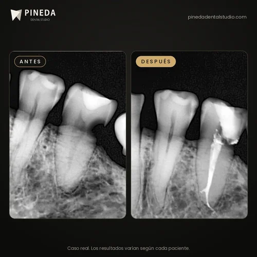 Radiografías antes y después de un tratamiento de conducto por infección en Pineda Dental Studio, Recoleta, CABA